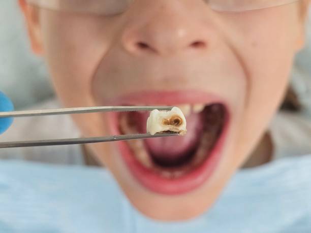 Best Emergency Dental Extractions in Bayside, WI